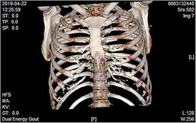 Gout in the Chest Misdiagnosed as Ankylosing Spondylitis